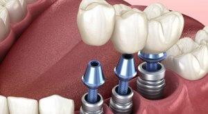 Что понимается под установкой зубного импланта